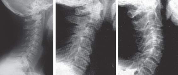 Мр картина нарушения статики шейного отдела позвоночника