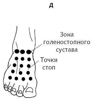 Рисунок стопы с точками по Гоникман. Комнатное образование на тыле стопы.