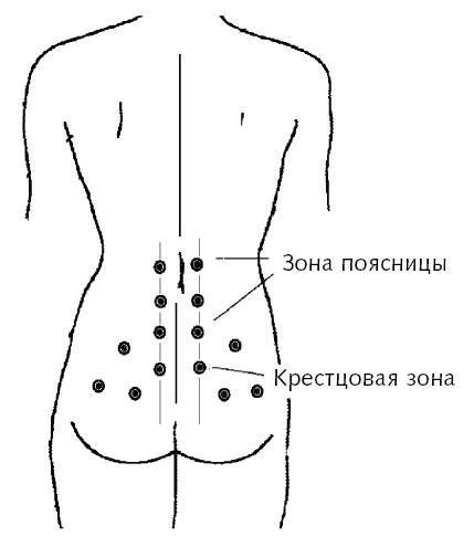 Схема установки банок на спину при остеохондрозе