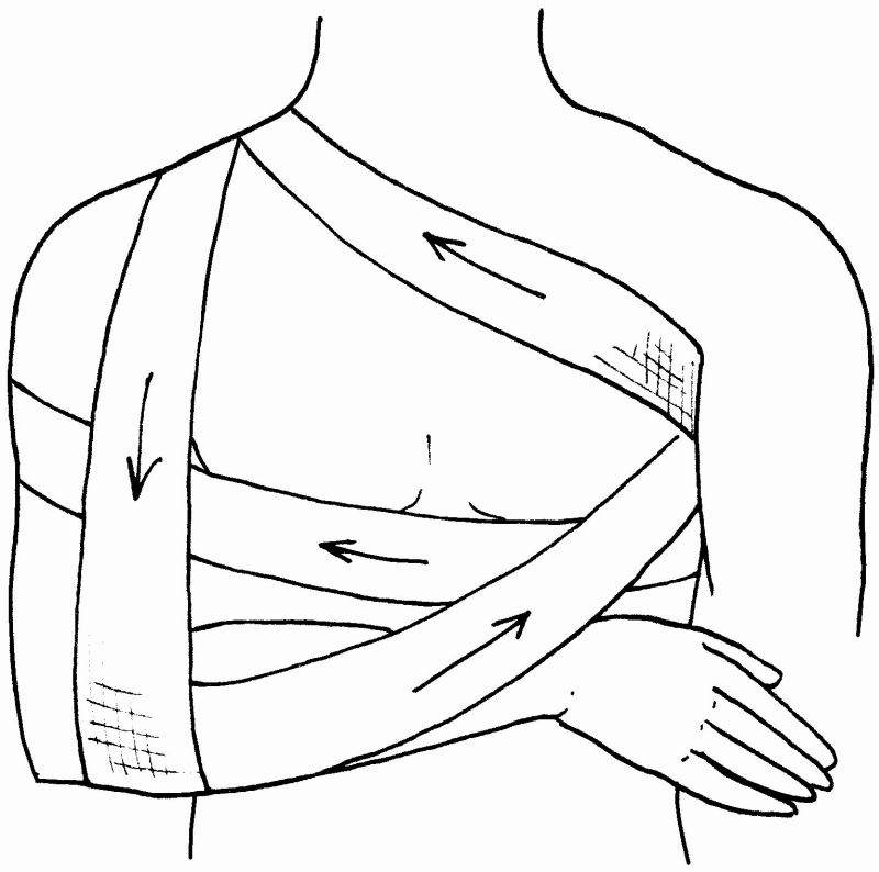 Десмургия повязка Дезо. Повязка Дезо техника наложения. Перевязка Дезо алгоритм. Бинтовая повязка Дезо.